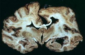 creutzfeldt-jakob-disease