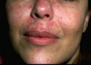 lupus-erythematosus