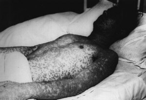 smallpox