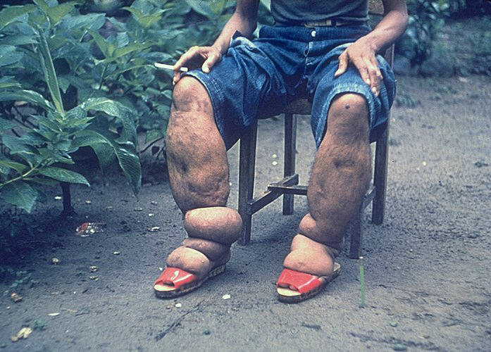 Elephantiasis Elephantiasis