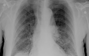Lower Respiratory Infections