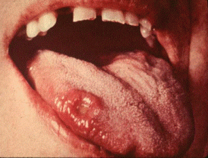 Syphilis